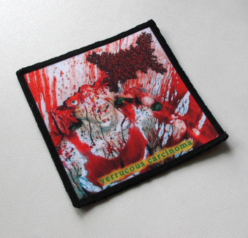 VISCERA INFEST - Verrucous Carcinoma.png